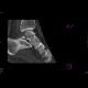 Comminuted fracture of talus: CT - Computed tomography